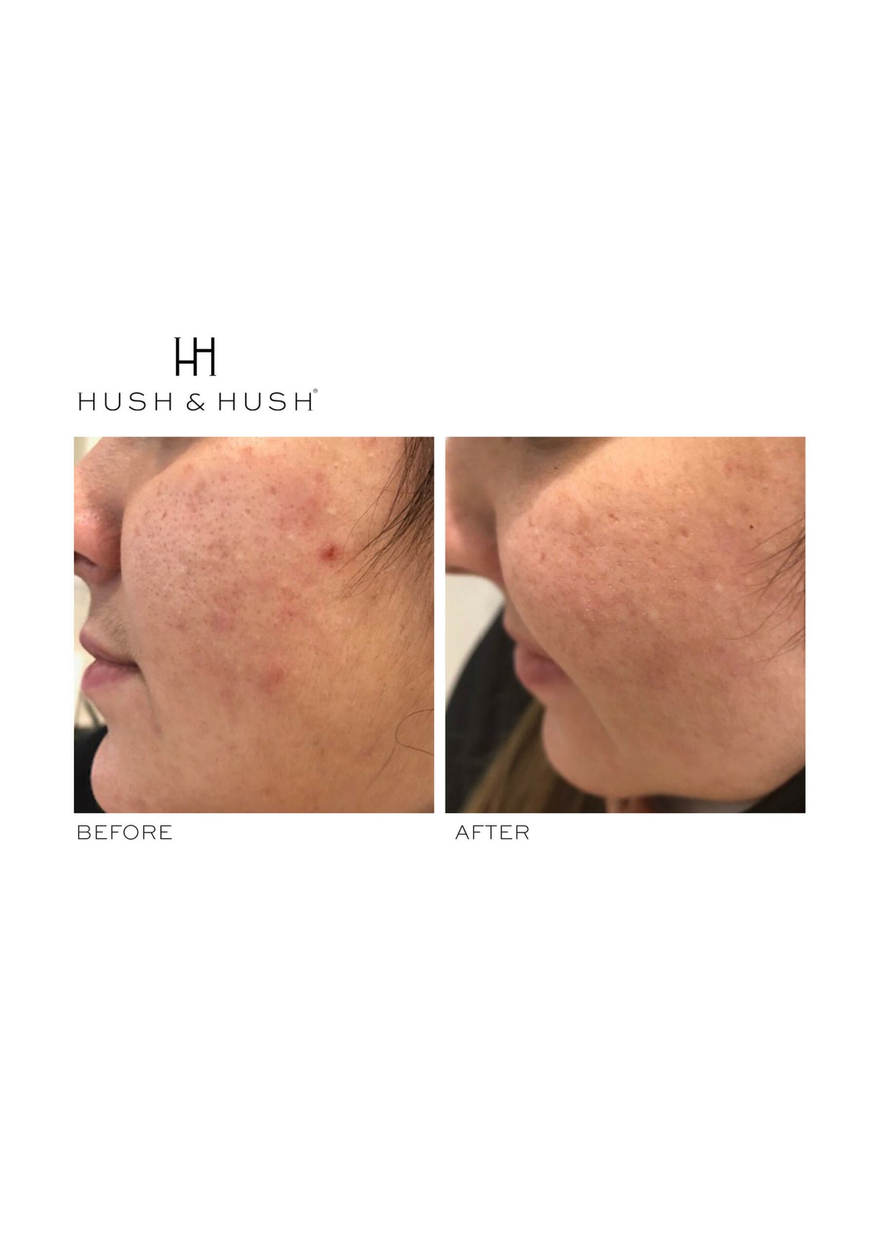SkinCapsule™ CLEAR+ - HUSH & HUSH – Image 6